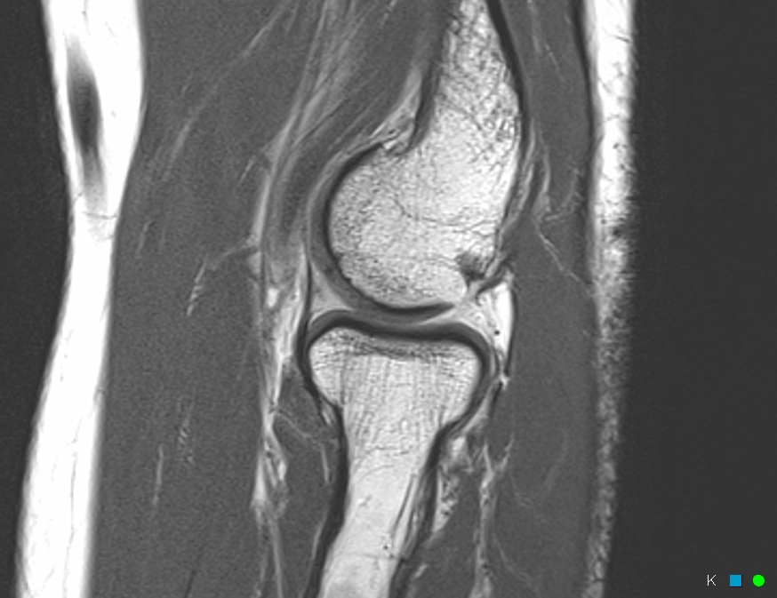 Figure 2 for case Cartilage loss in the capitellum